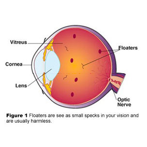 Floaters as vitreous opacities